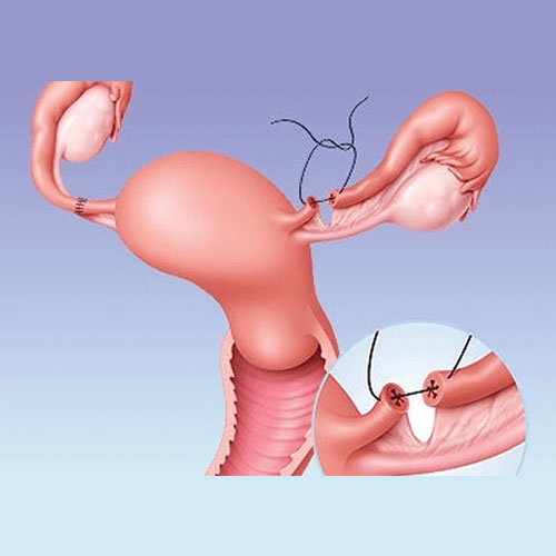 Tubal recanalisation in Jayanagar 7th Block